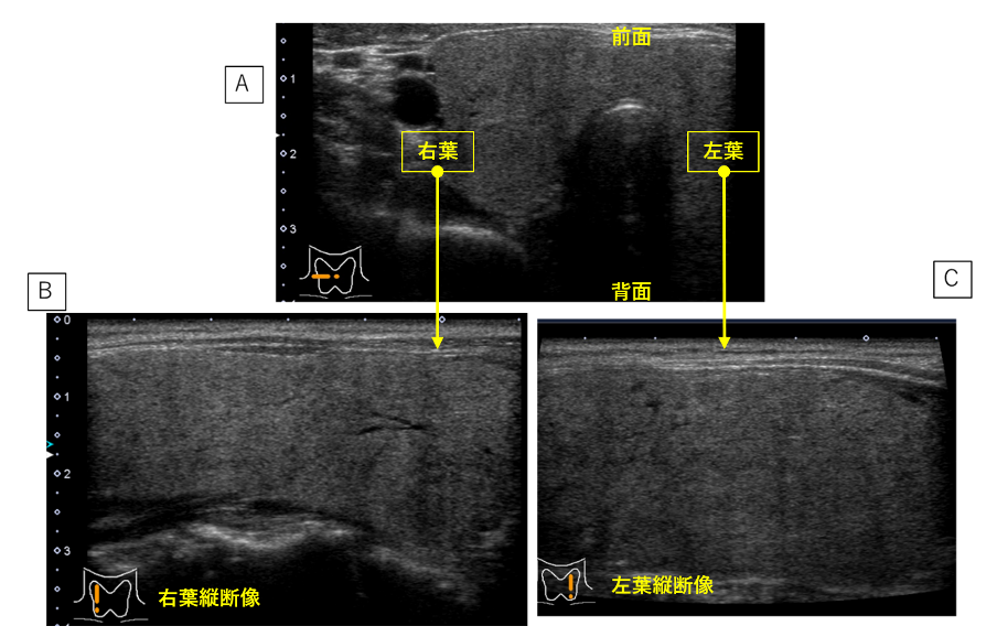 図2．バセドウ病の甲状腺エコー図
A:横断像　B：右葉縦断像　C：左葉縦断像
甲状腺右葉、左葉とも、正常よりも全体に腫大している（びまん性甲状腺腫）